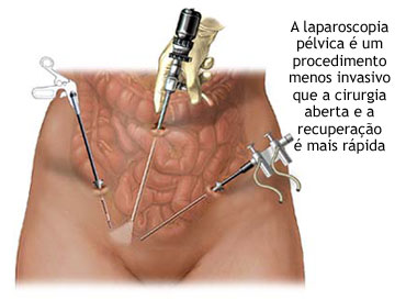 Laparoscopia - Cirurgia para retirada de Calculo Renal